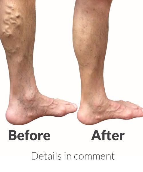 Varicose Veins Prevention Tips